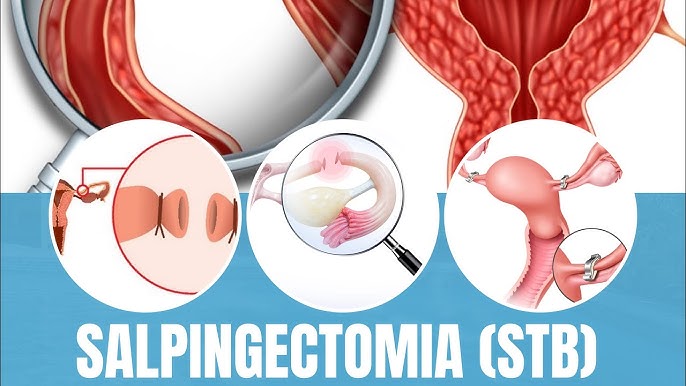 Ooforoplastia e Salpingectomia 