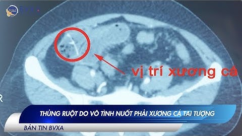 Bệnh nhân thủng ruột cấp cứu là màu gì