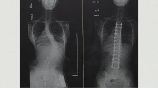 Shriners Children's Greenville - Scoliosis Awareness Month