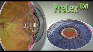 What is PreLex™?