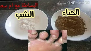 أسرع و أفضل علاج لفطريات وحكة القدمين بومشاش