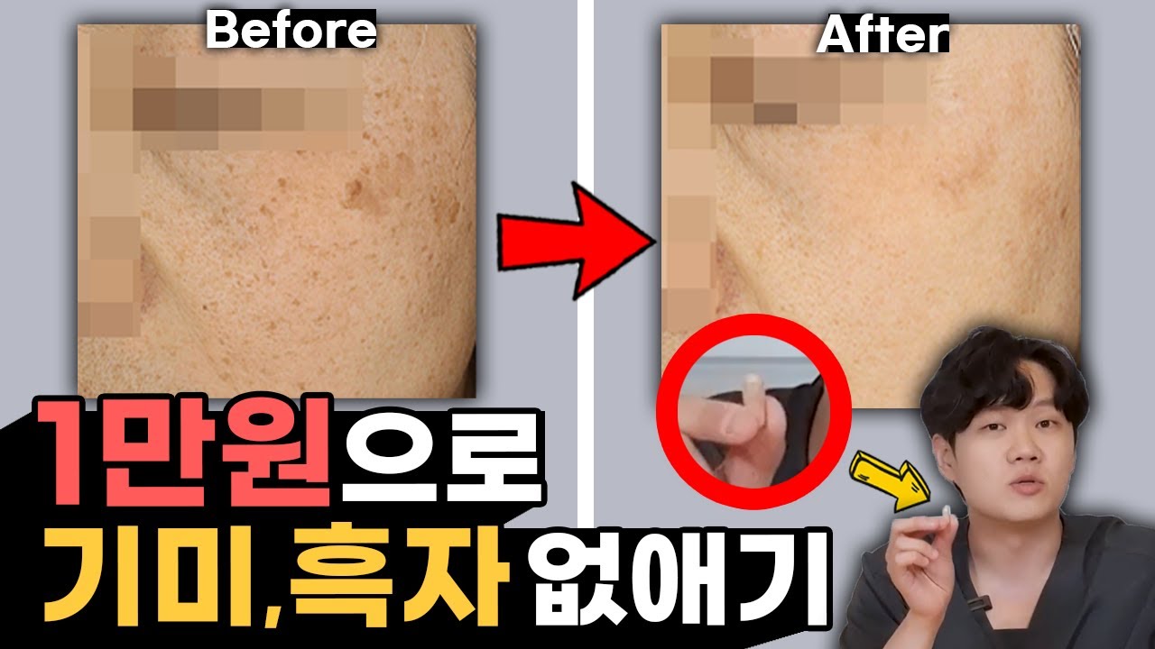 단돈 1만원으로 기미, 흑자 없애기 | 피부과 가기 전에 이것들부터 써보세요!! - YouTube