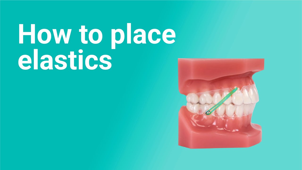 How to Place Elastics with Clear Aligners (9 Ortho Pro techniques)