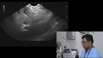 EUS-guided biopsy of lymph node to rule out lymphoma