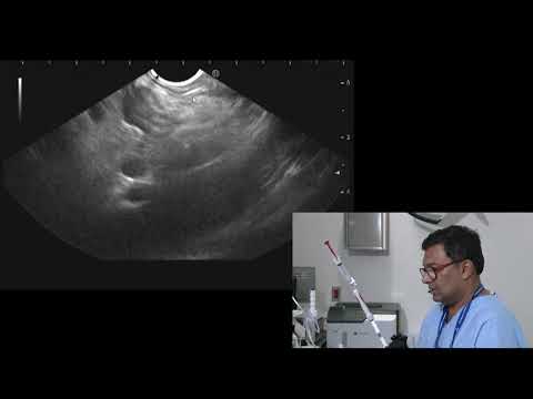 EUS-guided biopsy of lymph node to rule out lymphoma