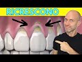 Come far ricrescere le gengive ritirate risolvere la retrazione gengivale a casa
