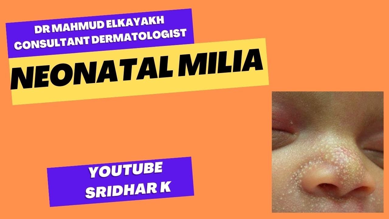 Neonatal miliaa dermatologist's perspective rash newbornrash milia