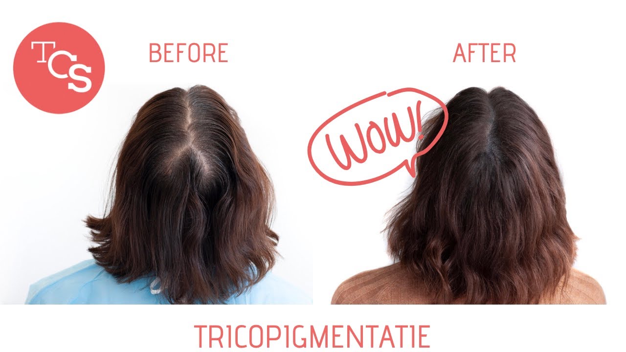 Tricopigmentatie - Demo Densiteit - Lize Feryn