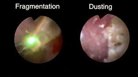 f-URS: Dusting vs Fragmentation (Holmium laser lithotripsy)