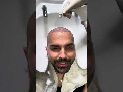 طريقة غسيل زراعة الشعر ما بعد العملية ثاني يوم ايدن الخالدي زراعة شعر