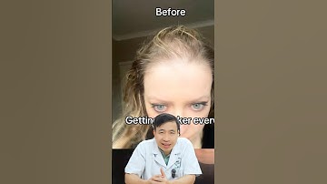 148 ngày sử dụng mino liên tục của cô gái rụng tóc Telogen🧐 #blackhair #caytoc #caytocblackhair