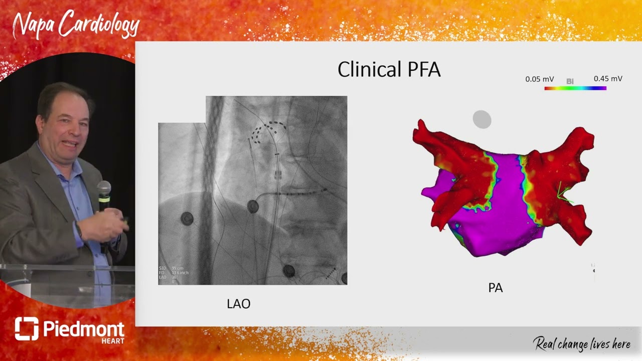 Pulsed Field Ablation: ADVENT Study