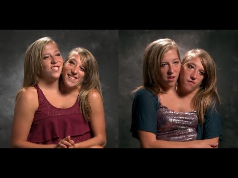 Невероятная история сиамских близнецов из США