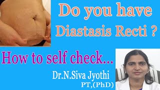 Do you have diastasis recti ? | self checking of diastasis recti |self checking abdominal separation