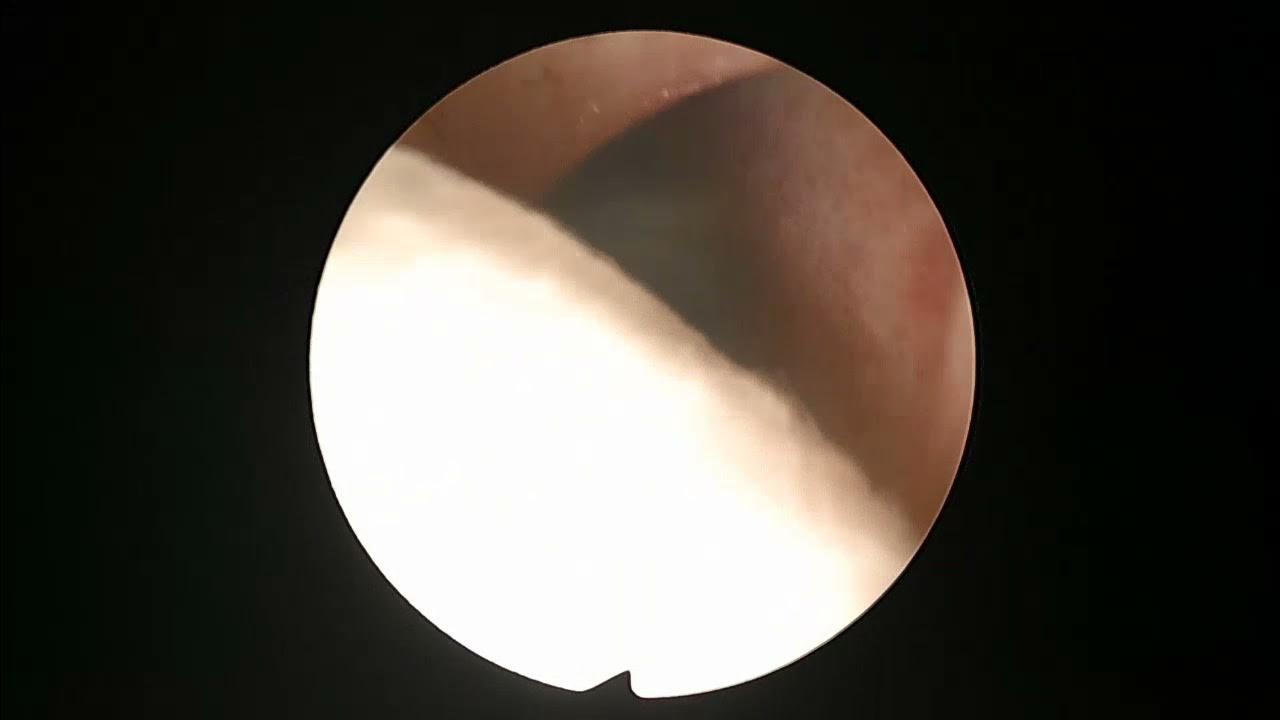 Nasal packing after endoscopic sinus surgery. Nasopore® YouTube