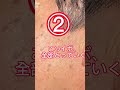 顔中のホクロ、シミとっただけで清潔感爆上がり😊BRIGHTS beauty clinic今村直樹