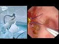 Flexible Ureteroscopy and Laser Dusting of 8 mm Kidney Stone