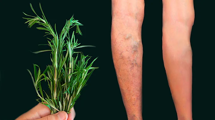 Unbelievable! Get rid of varicose veins with rosem...