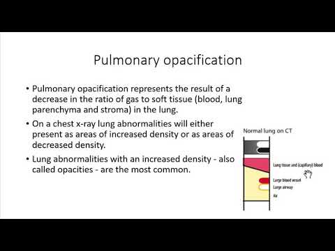 تفسیر گرافی قفسه سینه    دکتر شیدایی قسمت دوم