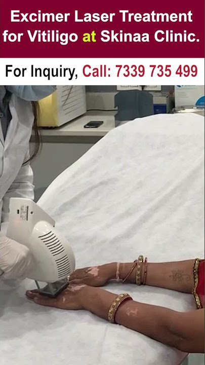 Excimer laser Treatment for Vitiligo at Skinaa clinic #shorts