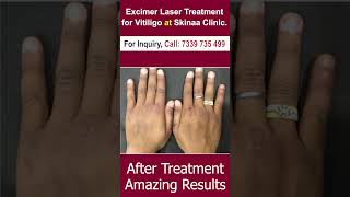 Excimer Laser Treatment For Vitiligo At Skinaa Clinic 