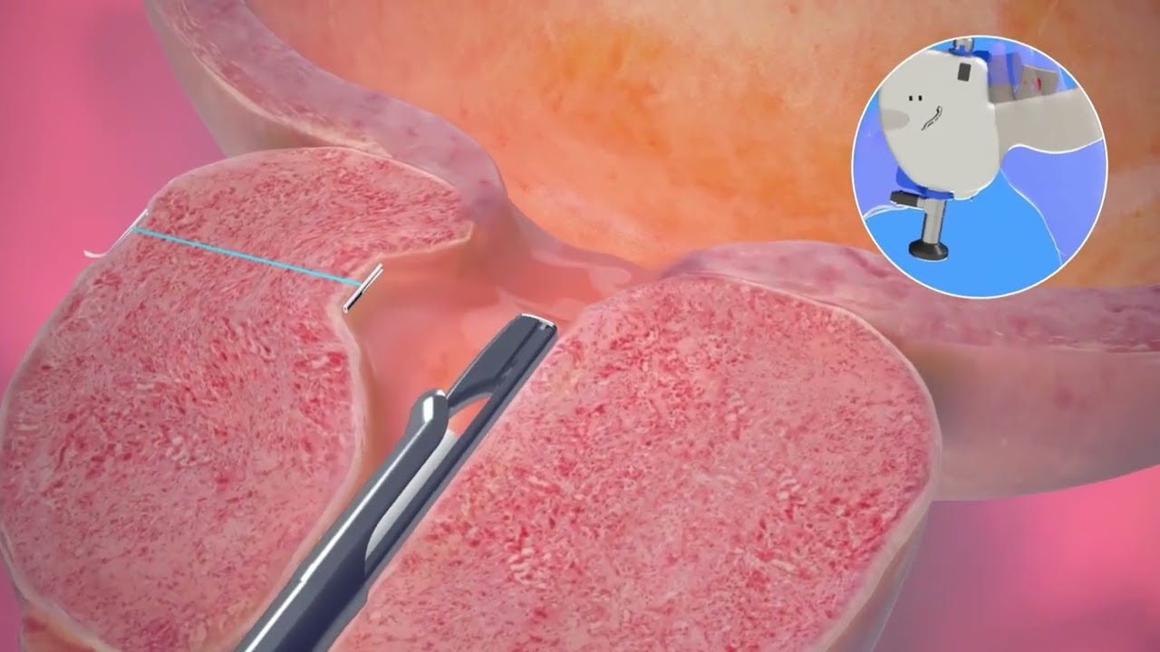 UroLift® Japan | Home