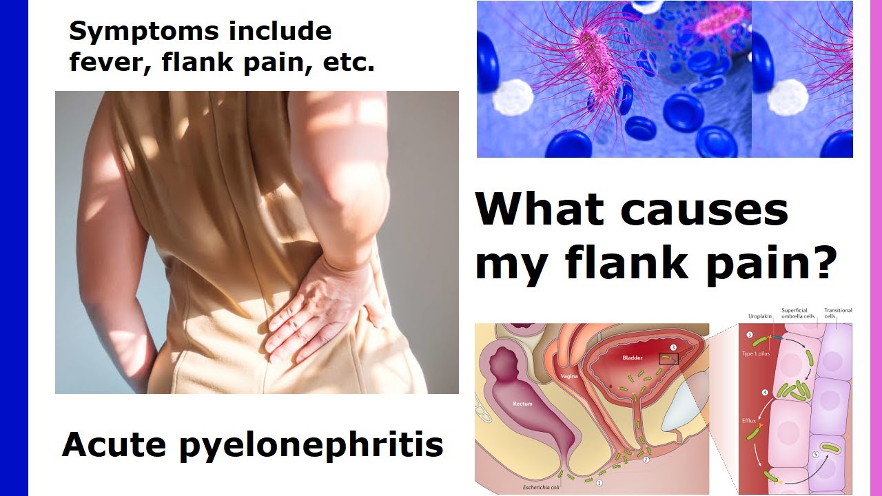 Acute Flank Pain