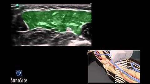 How To: Ultrasound Guided Median and Ulnar Nerve Block 3D Video