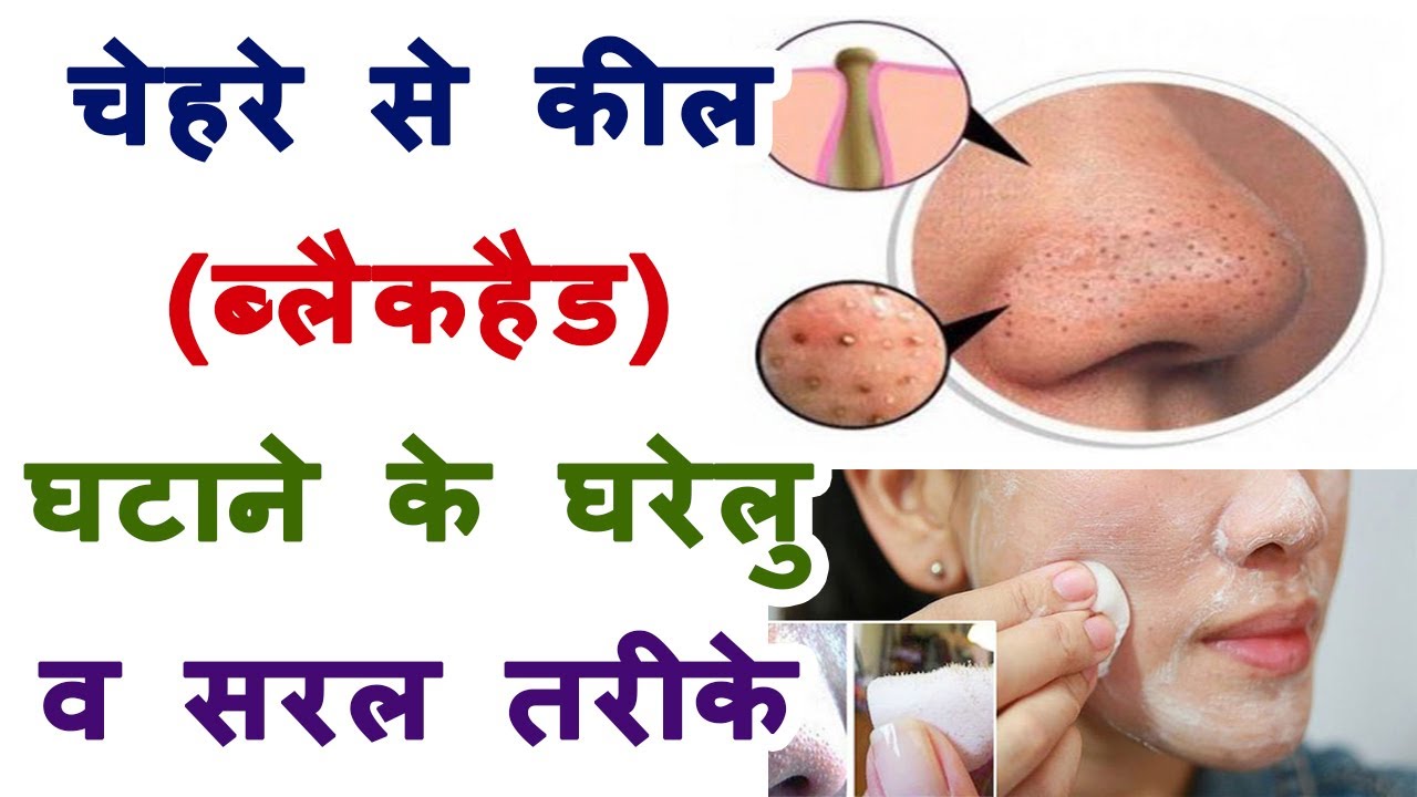 Home Remedies For Blackheads In Hindi Get Rid Of Acne On Nose Face CureTreatment At Home YouTube