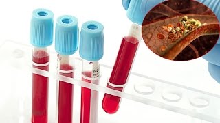 Gli esami del sangue (trigliceridi, HDL, glicemia)