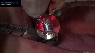 Pyramidion in atrophic maxilla - Dr. Michael Alterman