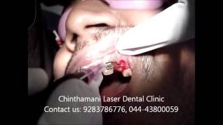Thumbnail of Permanent Canine exposure using Zolar dental diode laser