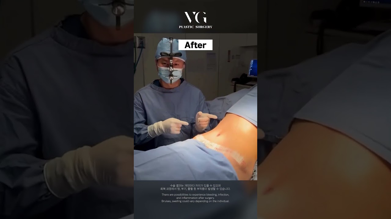 [維麗整形外科診所] 鬆弛的腹部贅肉，完美解決！ #腹部贅肉 #腹部贅肉去除 #腹部拉提