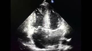 Negative contrast echocardiography, how can it be useful