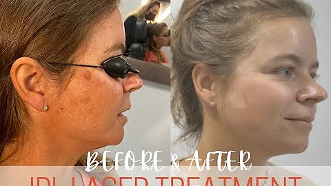 Intense Pulse Light (IPL) Treatment: Before and After Removing DARK SPOTS, WRINKLES, and More!