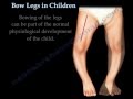 Bow Legs In Children - Everything You Need To Know - Dr. Nabil Ebraheim