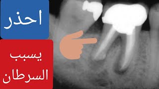 الرد على فيديو الاسنان د. كريم علي ! علاج الجذور يسبب السرطان ؟ هل يجب ان تخلع اسنانك ؟ ج1
