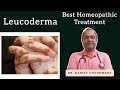 Leucoderma | सफेद दाग Best Homeopathic Treatment