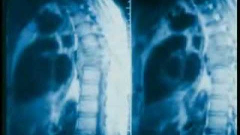 RainDrop Technique Part 1