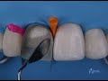 Direct composite veneers with layering technique