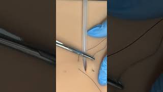 Celebrity Purse string + finger trap suture Wealth