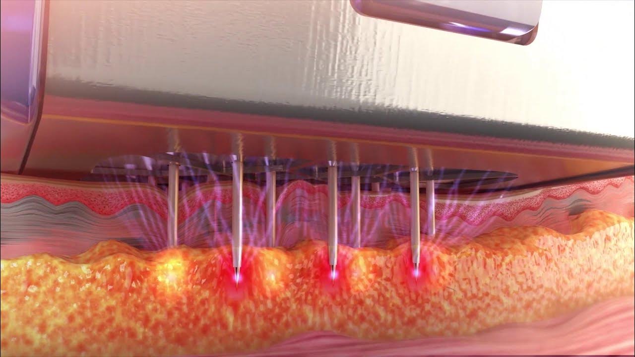How Does RF Microneedling Work? YouTube