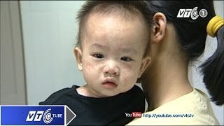 Cẩn thận nhầm bệnh sởi thành sốt phát ban | VTC