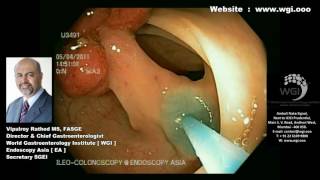 Endoscopic procedure for Polypectomy