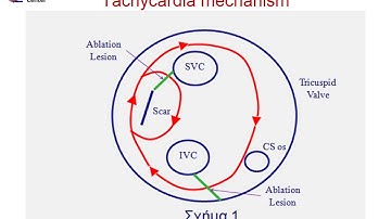 Peri-incisional macro-reentry tachycardia