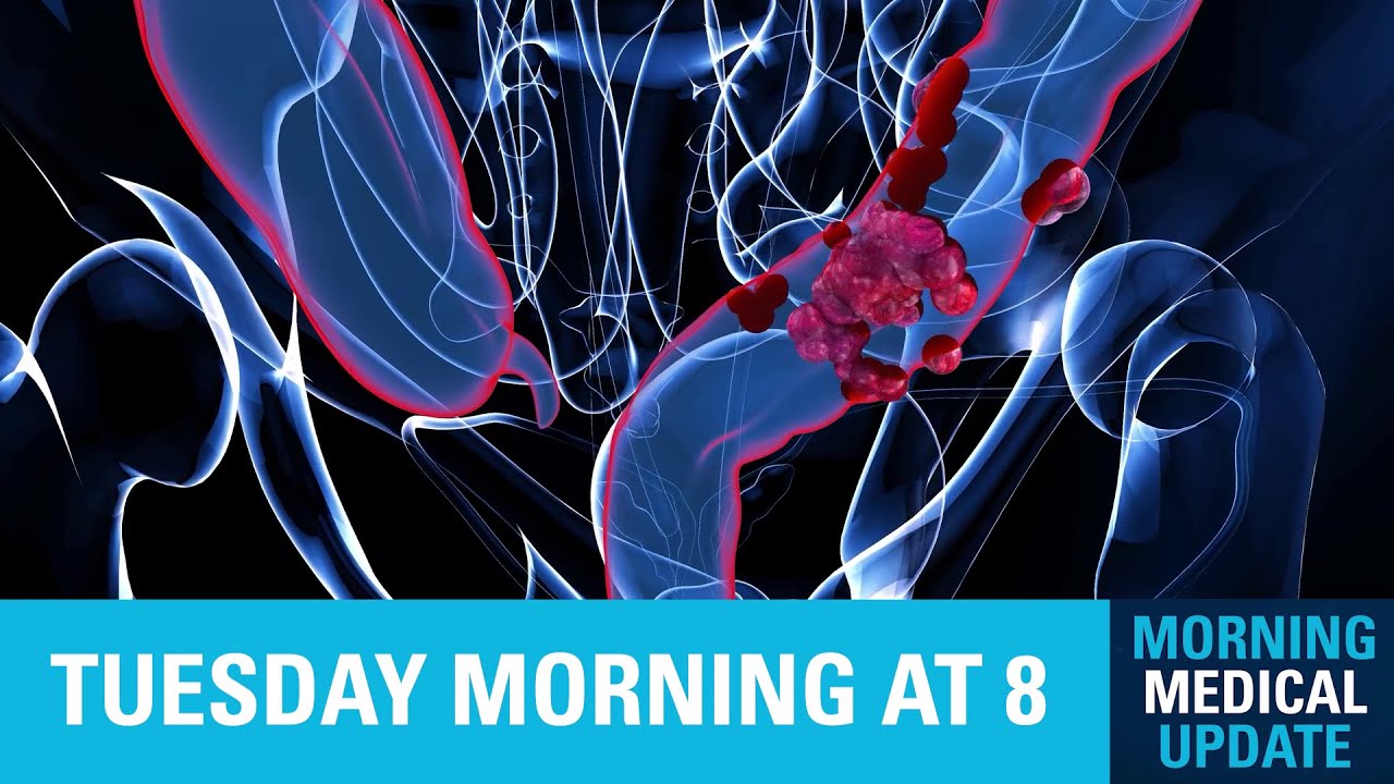 Morning Medical Update - Colon Cancer Epidemic