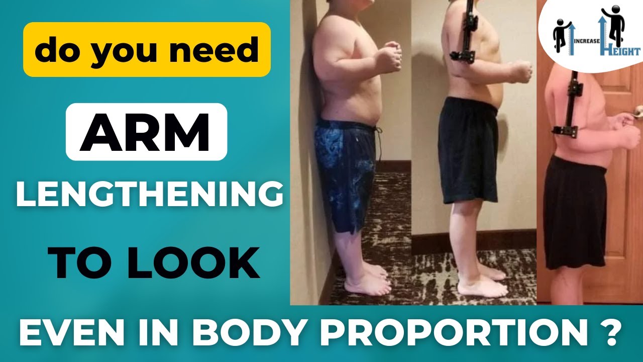 Do you need Upper Limb Lengthening to look proportional? Arms