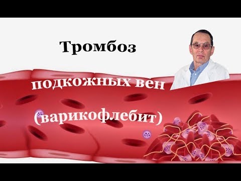 Лечить тромбофлебит поверхностных вен. Знания для ВСЕХ.