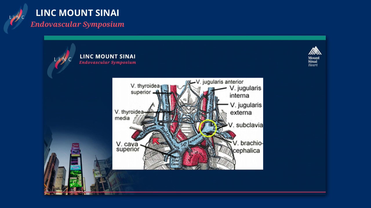 Managing Central Venous Stenosis in Dialysis Patients