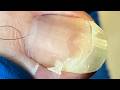 Ingrown Toenail Trimming Collection Perfect Solution To The Problem【Xue Yidao】